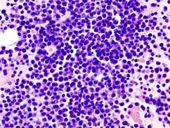 Multiple_myeloma_(2)_HE_stain.jpg