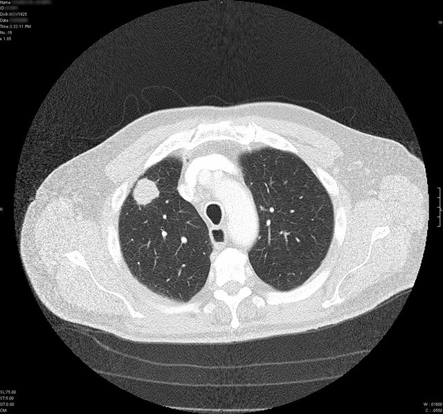 LungCancer.jpg