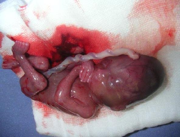 aborto-10abril15.jpg