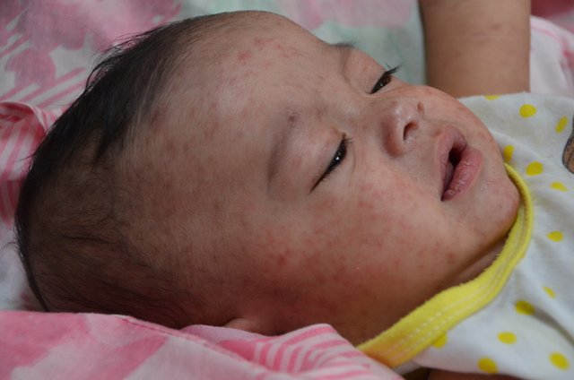 Measles_child_Philippines.jpg