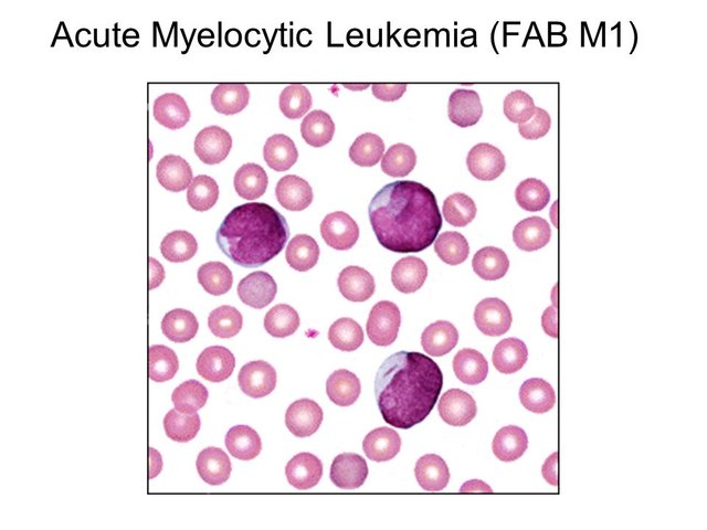 Acute+Myelocytic+Leukemia+(FAB+M1).jpg