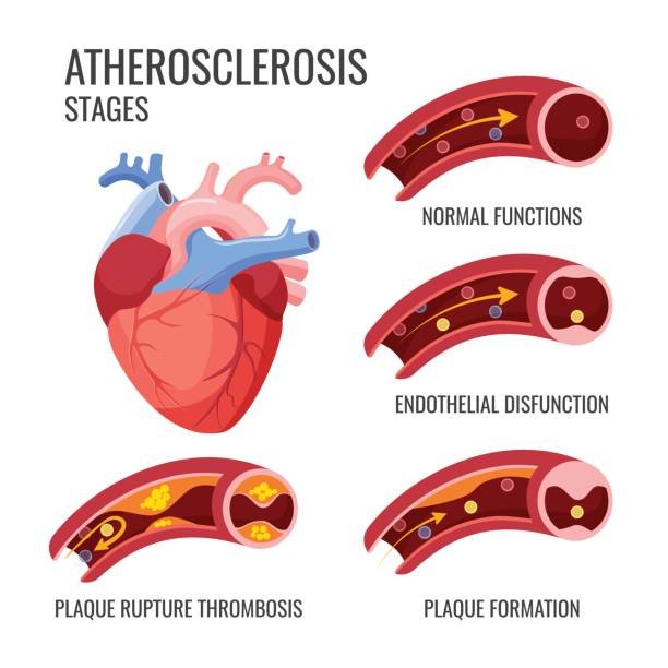 arteries-clipart-arteriosclerosis-2.jpg