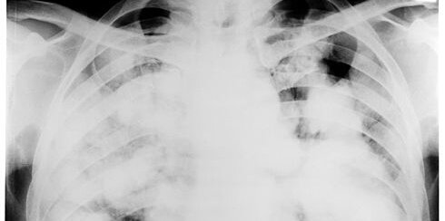 X-ray_of_chest_showing_tuberculosis_Wellcome_M0009367 (1)-1.jpg