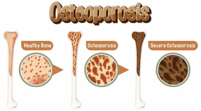 comparison-normal-bone-bone-with-osteoporosis_1308-132741.webp