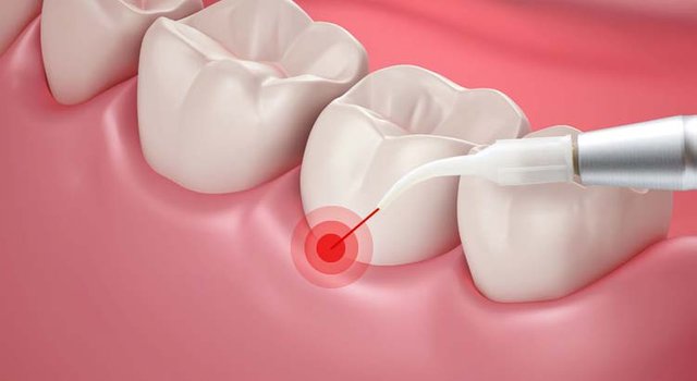 periodontal-laser-therapy-gum-disease-opt.jpg