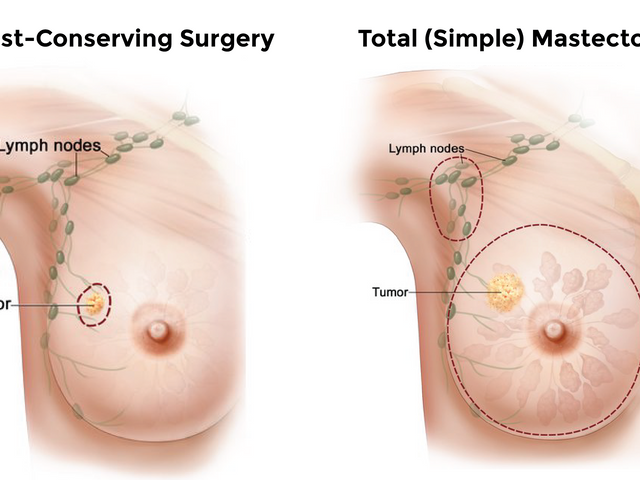 CGOV-14676 mastectomy for early-stage breast cancer_16x9.png