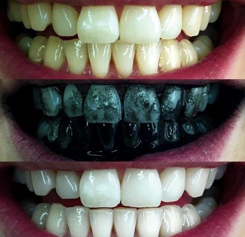 charcoal-teeth-whitening-powder-31396832010_large.jpg