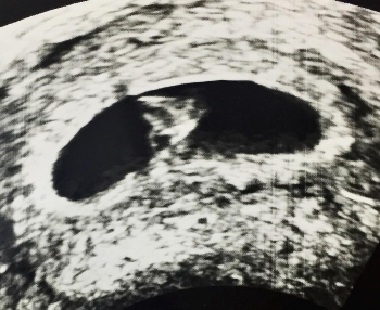 임신5주 (4).png