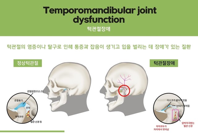 턱관절장애 턱관절통증 종로한의원 종각한의원.jpg