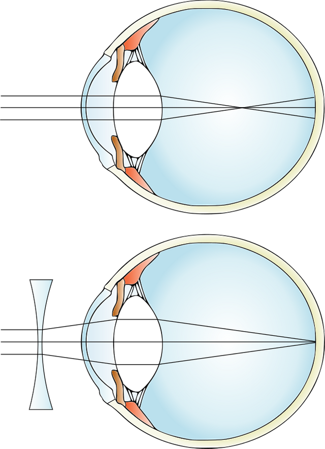 Myopia_and_lens_correction.svg.png