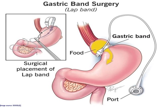 Adjustable Gastric.jpg