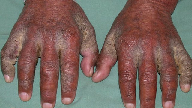 642x361_Scabies_SLIDE_5.jpg