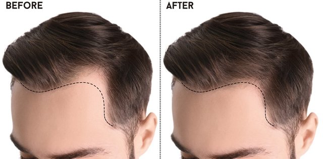 Hair Transplant Market.jpg