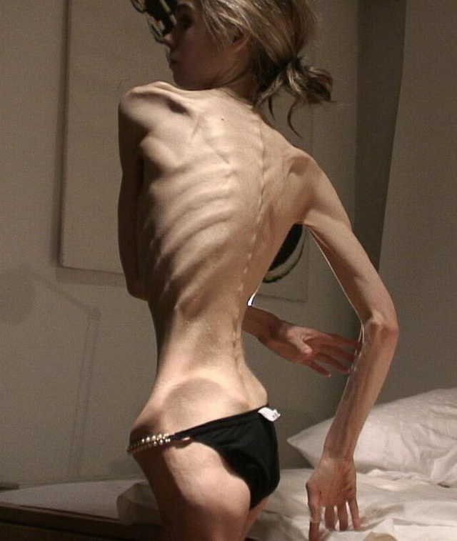 Anorexia-cuando-2.jpg