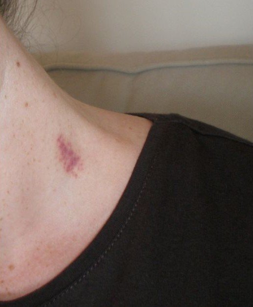 8 tips on How to get rid of hickeys.jpg