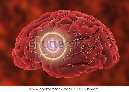 brain-stroke-concept-migraine-headache-450w-1036394275.jpg