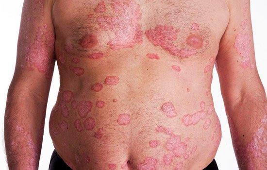 psoriasis-symptoms-and-signs.jpg