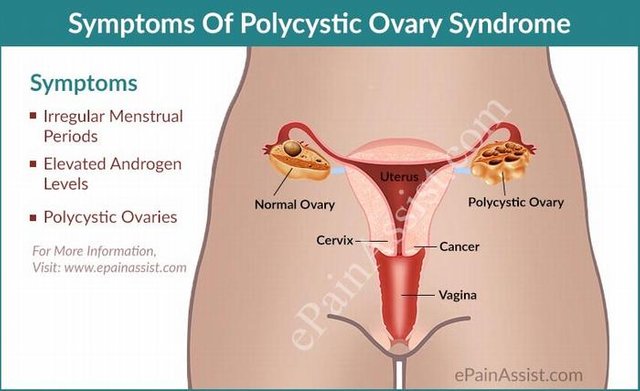 What-is-polycystic-ovary-syndrome.jpg