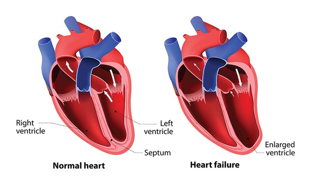 heart-failure-A-960x571.jpg