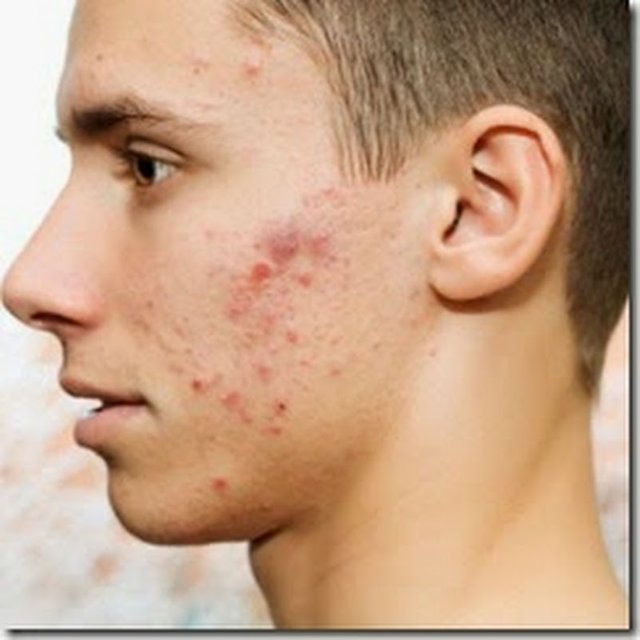 Acnes-on-face-treatment7.jpg