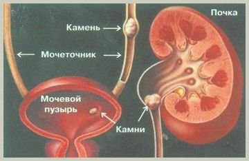 priznaki-mochekamennoj-bolezni-simptomatika-i_1.jpg