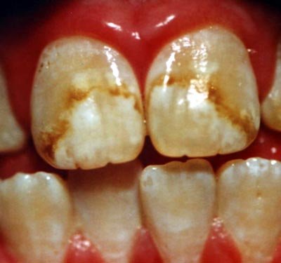 dental-fluorosis.jpg