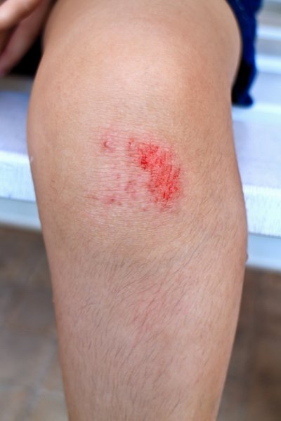 depositphotos_63206887-stock-photo-scraped-knee.jpg