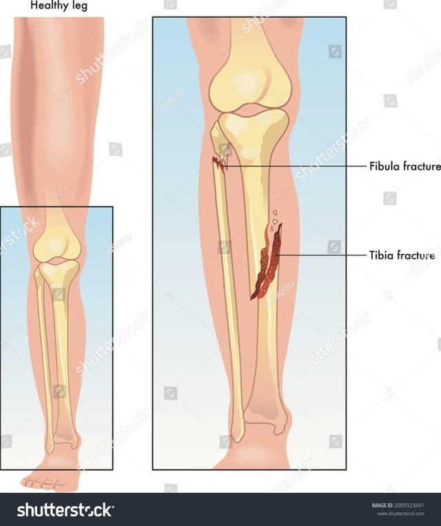 stock-vector-a-medical-illustration-comparing-a-healthy-leg-and-a-leg-with-fractured-tibia-and-fibula-2005923491.jpg