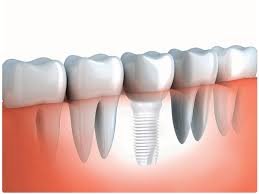Zirconia Dental Material.jpg