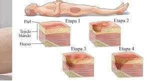 GRADOS-ESCARAS-PARAPUPAS.jpg