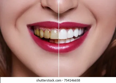 woman-teeth-before-after-dental-260nw-754146658.webp