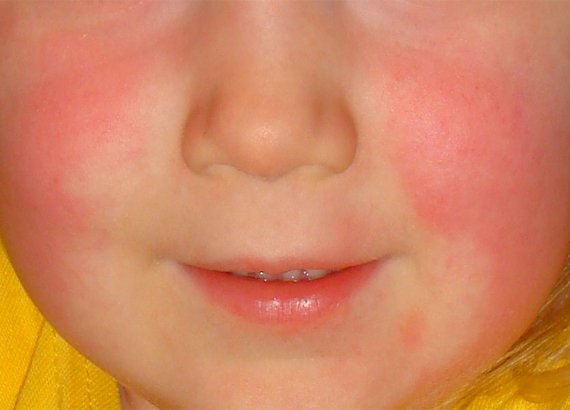 Baby With Rash All Over Body.jpg