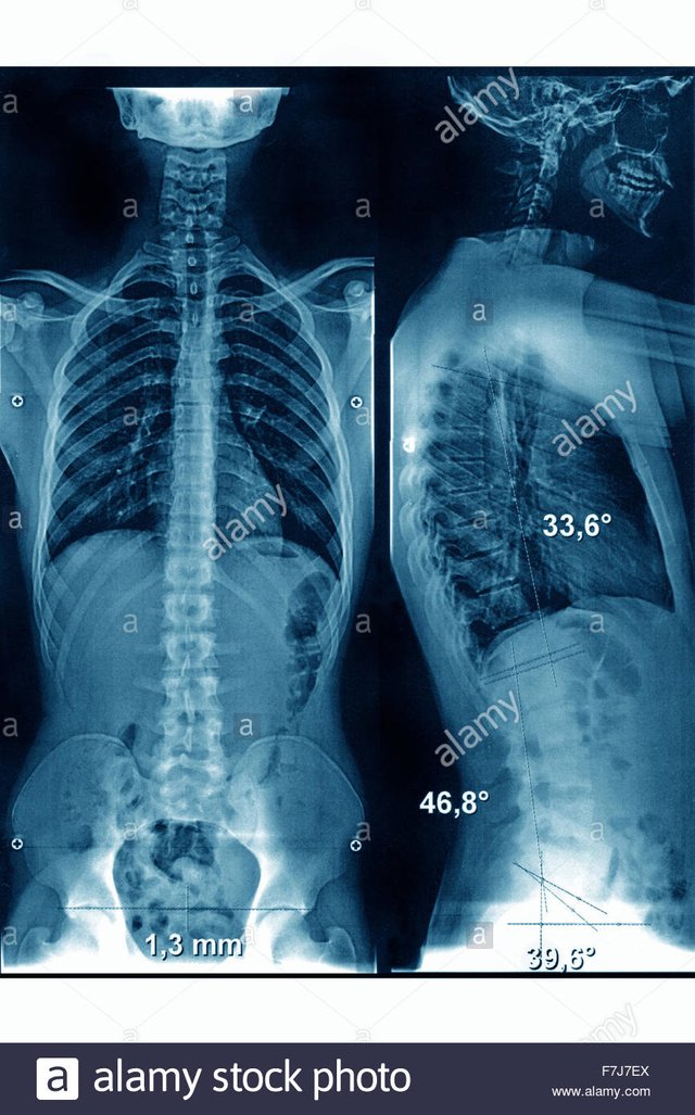 spinal-column-x-ray-F7J7EX.jpg