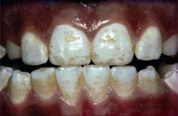 dental-fluorosis.jpg