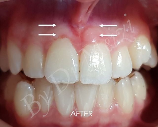 After Laser Treated Frenectomy.png