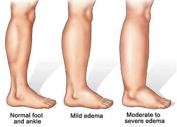 edema.jpg