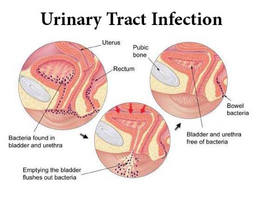Urinary-tract-infections-UTIs-in-adults.jpg