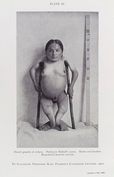 Female_dwarf,_the_result_of_rickets,_c._1912_Wellcome_L0033871.jpg