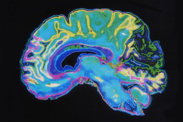 Brain-MRI-716x478.jpg