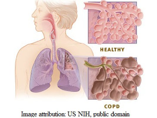 Copd versus2 healthy lung NIH free.jpg