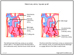 internal mammary artery ligation.png