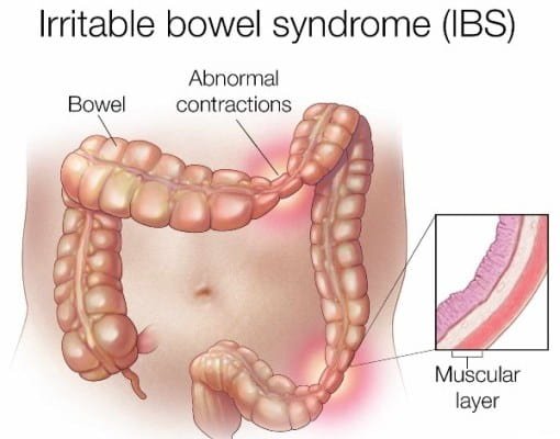 What-is-irritable-bowel-syndrome-IBS-Causes-Treatments-Diet-is.jpg