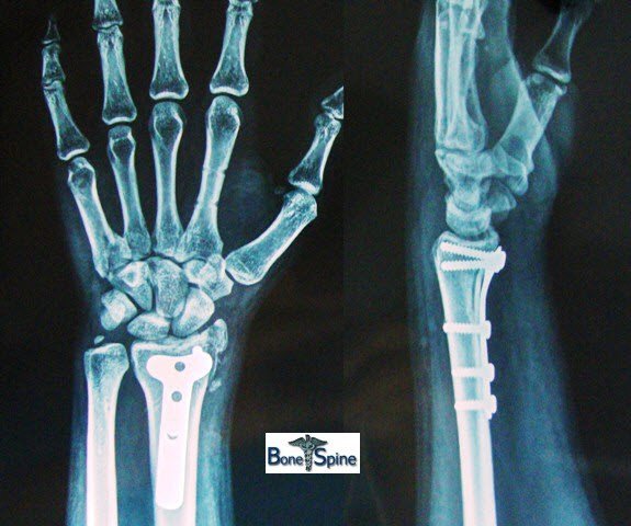 fracture-radius-plate.jpg