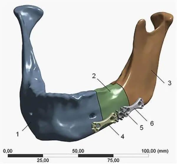 Alveolar bone repair.jpg