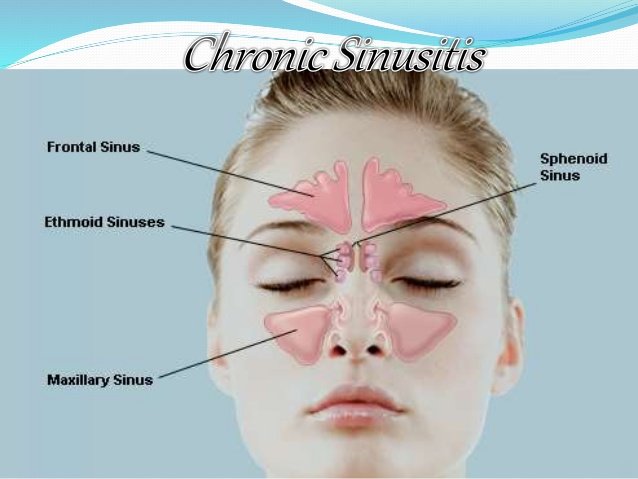 chronic-sinusitis-1-638.jpg