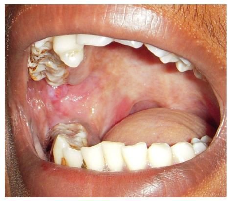 Figure 4 Redness and irregular cobble-stone….jpg