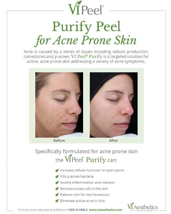 Chemical Peel For Acne