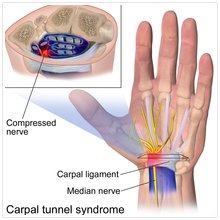 Tunnel tunnel syndrome.jpg