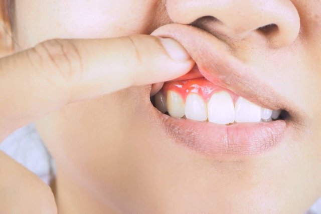 Everything You Should Know About Gum Disease.jpg