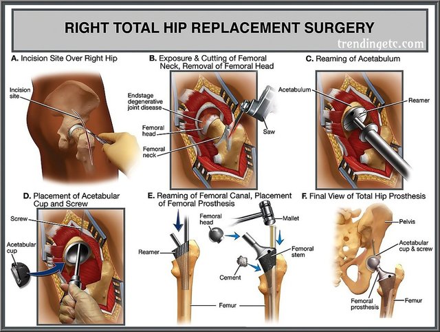 Hip Replacement Surgery.jpg